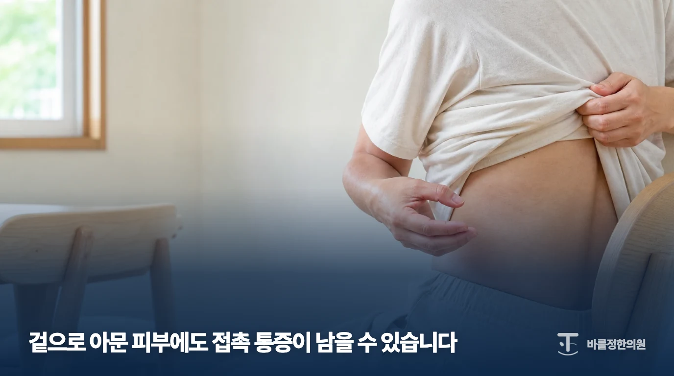 몸통 옆 아픈 부위를 손으로 짚는 대상포진 후 통증 설명 이미지
