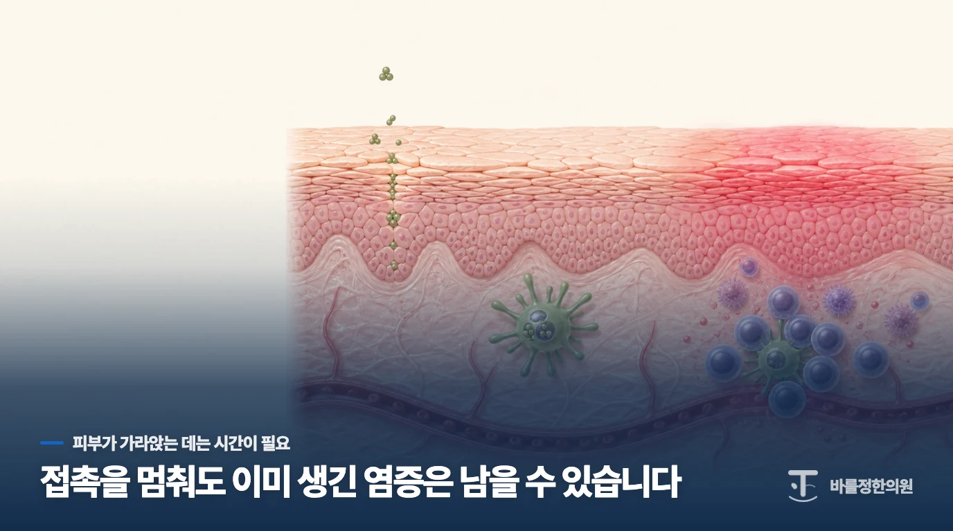 접촉을 끊어도 피부가 바로 잠잠해지지 않는 이유