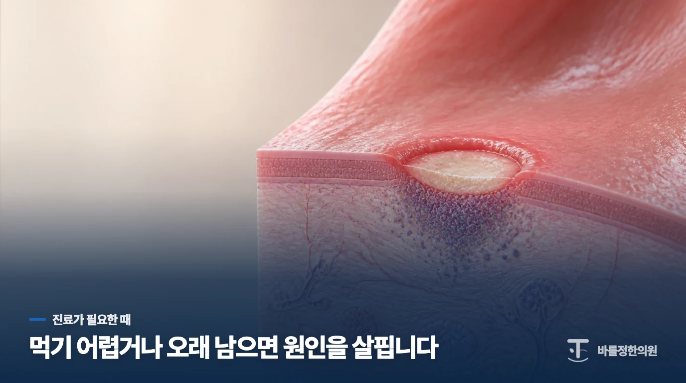 식사를 못 하게 만드는 통증과 오래 남는 궤양은 진료로 이어집니다