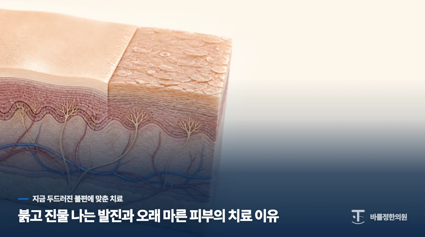 붉고 진물 나는 발진과 오래 마른 피부의 치료 이유