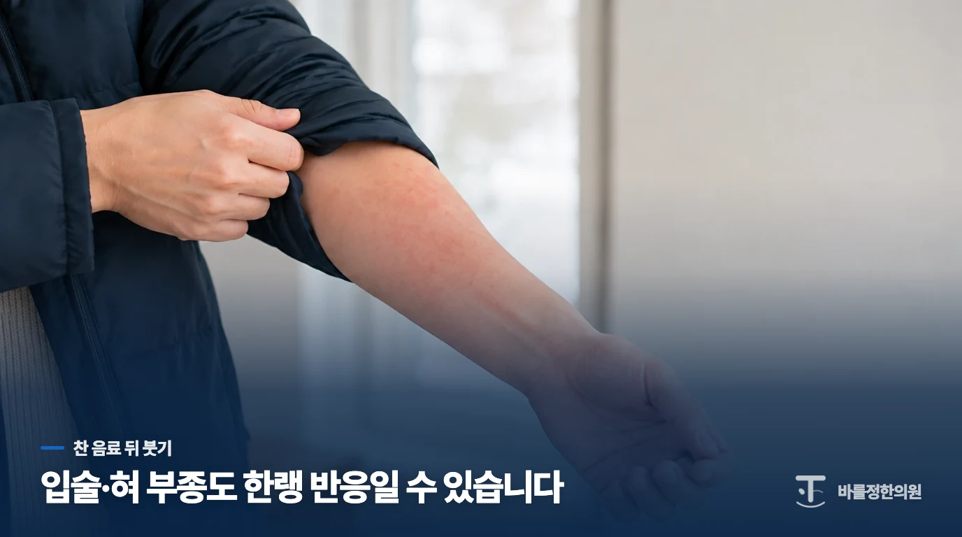 찬 음료 뒤 입술·혀가 붓는 것도 한랭두드러기일 수 있습니다