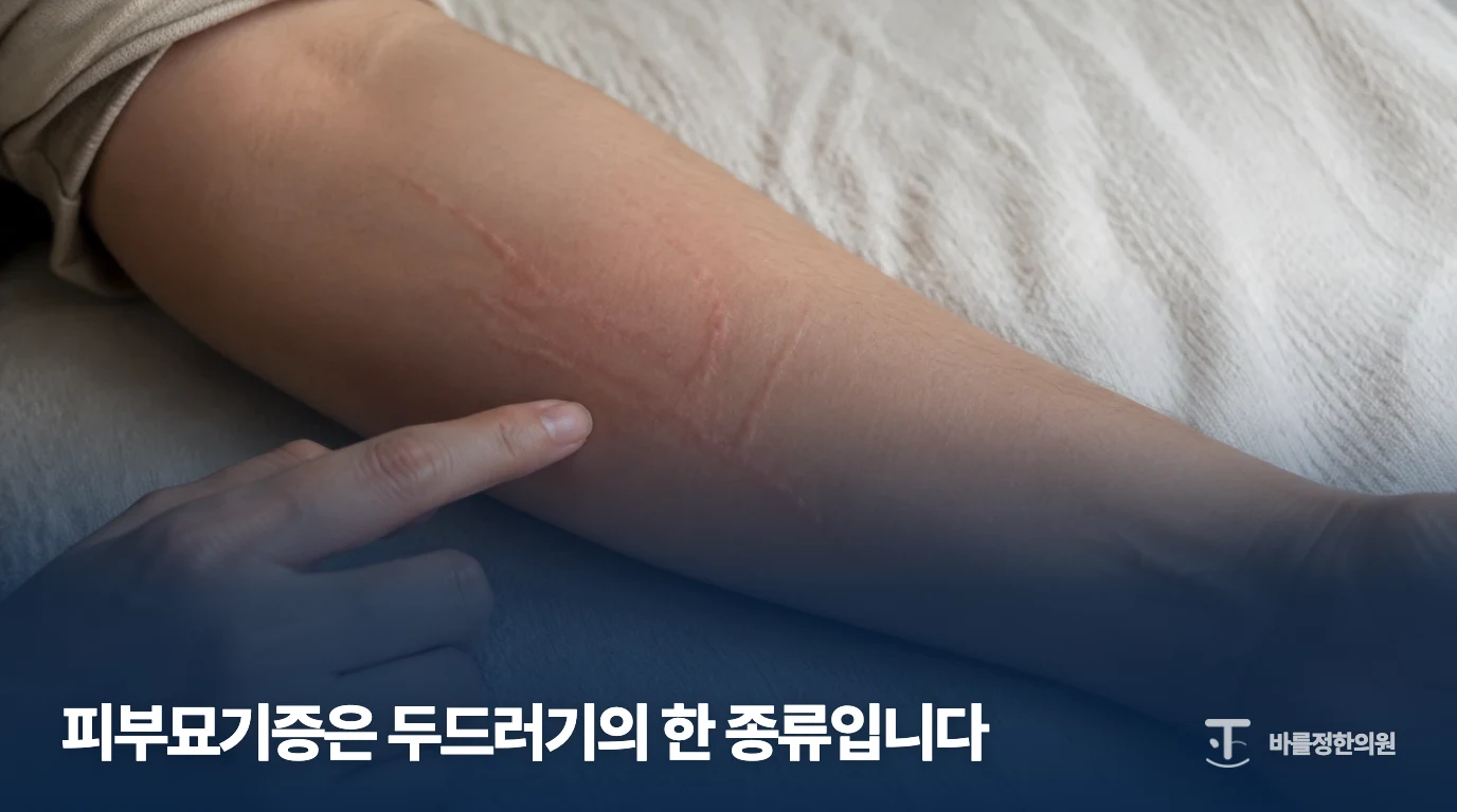 팔에 선 모양의 부풀음이 보이는 피부묘기증 설명 이미지