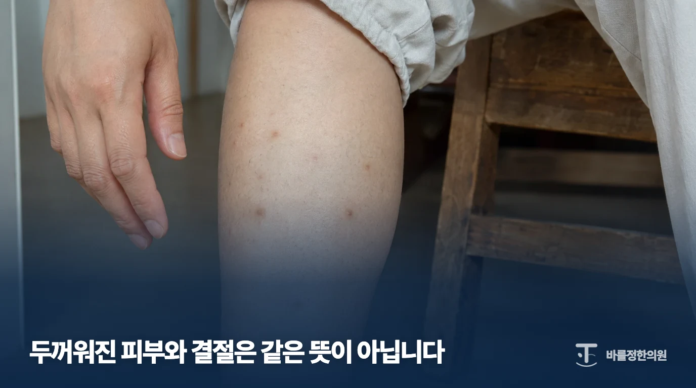 가려운 결절이 보이는 피부 상태를 설명하는 이미지
