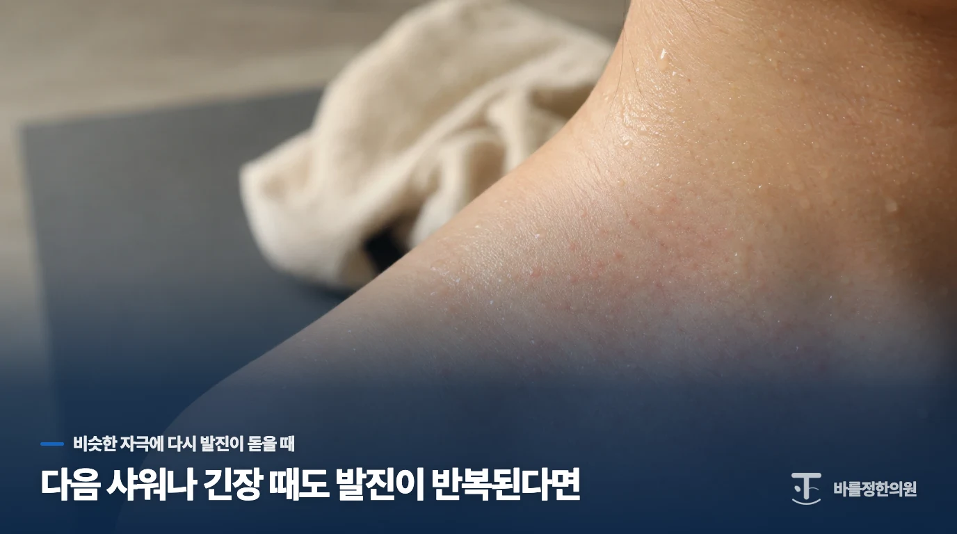 다음 샤워나 긴장 때도 발진이 반복된다면