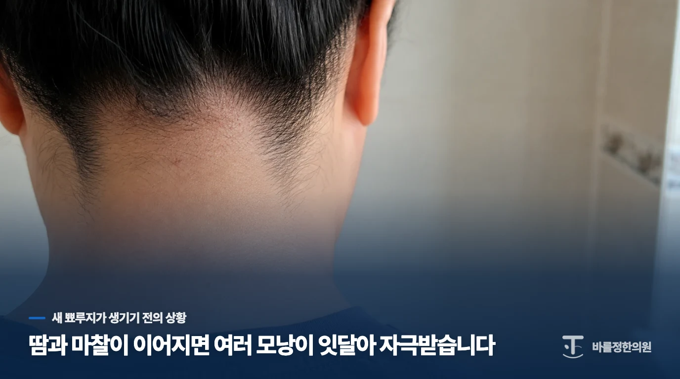 땀과 마찰이 이어지면 여러 모낭이 잇달아 자극받습니다