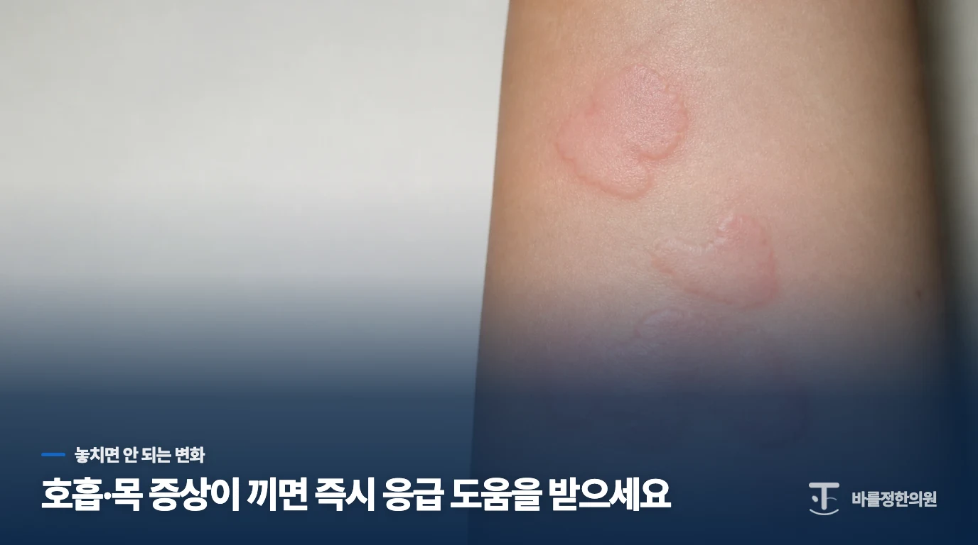 목이 붓거나 숨이 차면 피부 진료보다 응급 대응이 먼저입니다