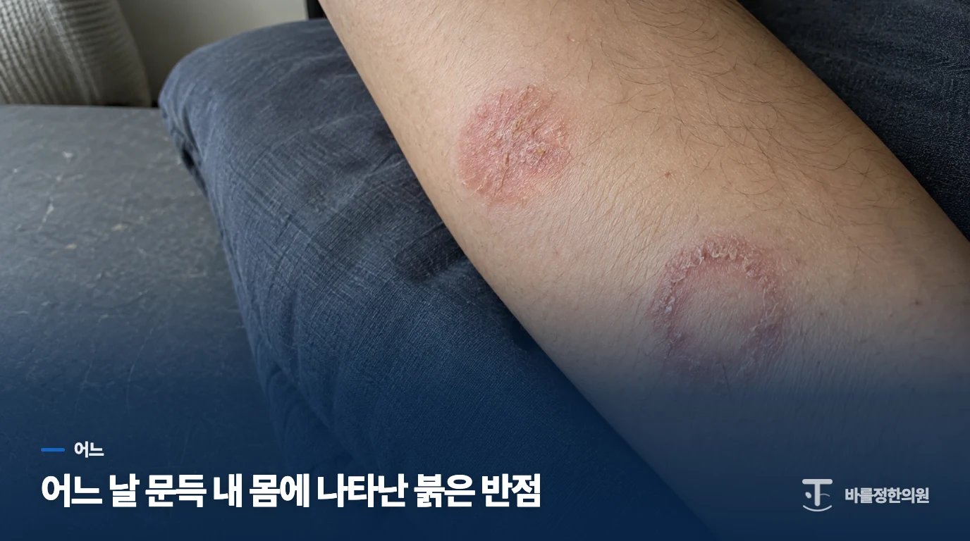 어느 날 문득 내 몸에 나타난 붉은 반점